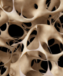 osteoporoza vzrok za bolecine v kolkih