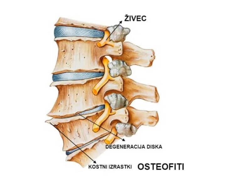 OSTEOFITI KOSTNI IZRASTKI