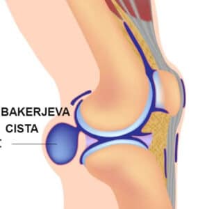 BOLECINA NA ZADNJI STRANI KOLENA BAKERJEVA CISTA 1